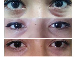 antes y después ojeras