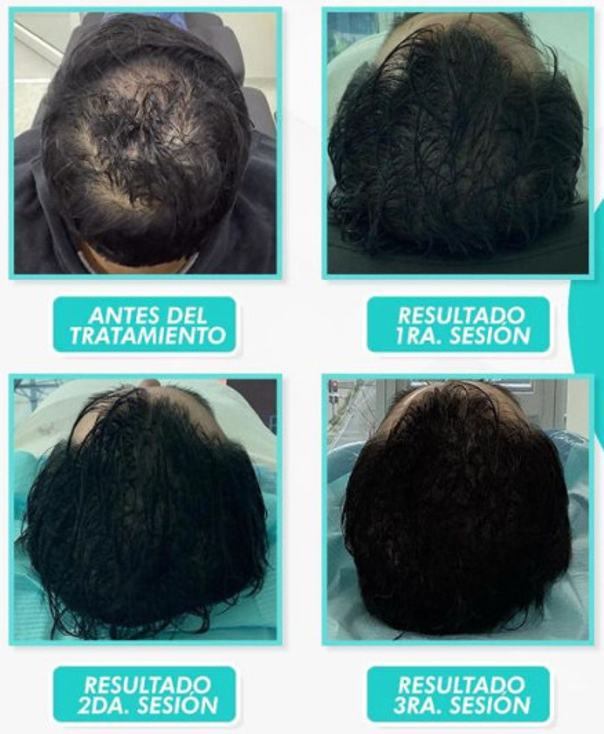  La alopecia puede depender de muchas causas y factores