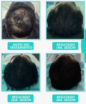 La alopecia puede depender de muchas causas y factores