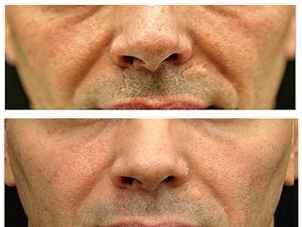 antes y despues de un peeling