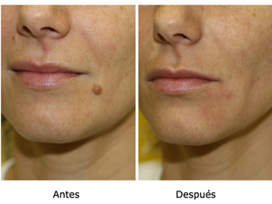 Eliminación de lunares