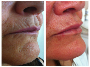 Antes y después aplicación ácido hialurónico