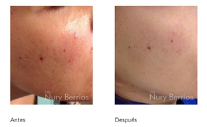 antes y después de mesoterapia