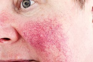 tipos de rosacea
