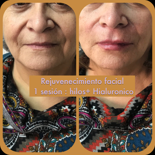 Rejuvenecimiento facial