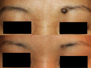 Antes y después eliminación de un lunar