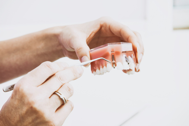 ventajas de una extracción dental