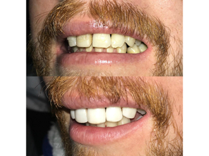 antes y después blanqueamiento dental