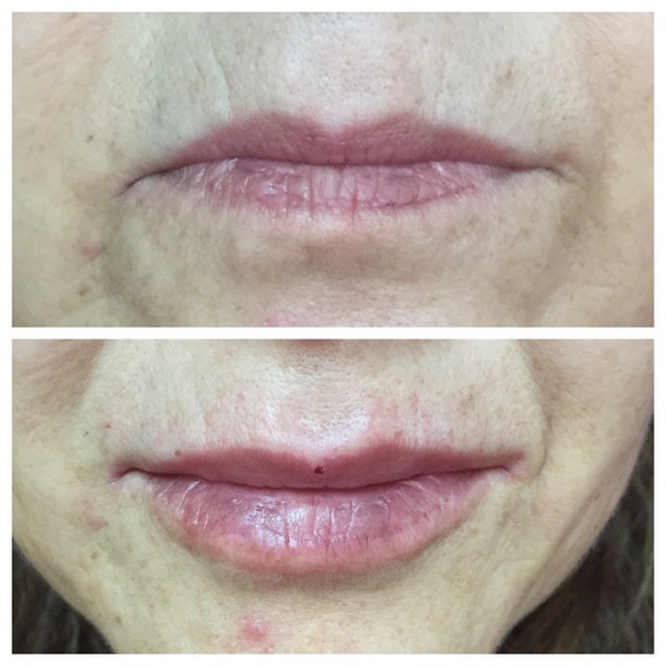 Antes y después aumento de labios