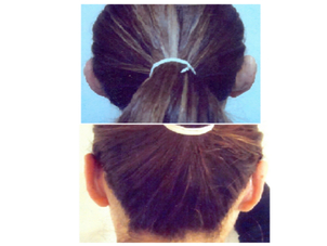 Antes y después otoplastia