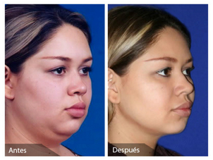 Resultados liposucción papada