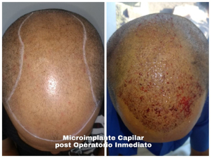 implante capilar en chile