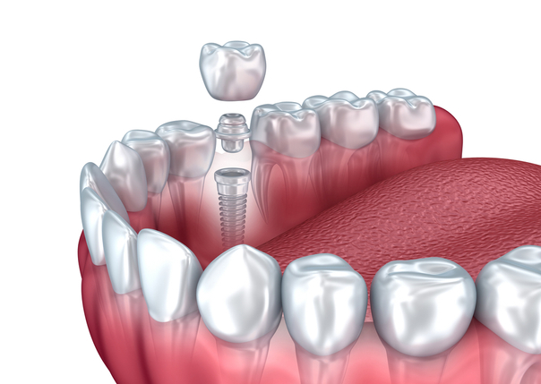 coronas dentales