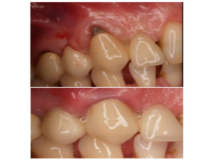 endodoncia