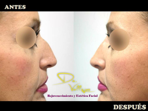 rinomodelarcion antes y después