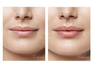 Resultados ácido hialurónico