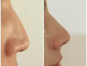 Antes y después rinomodelación con ácido hialurónico