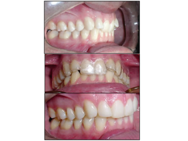 resultados ortodoncia invisible