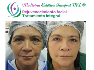 Antes y después de rejuvenecimiento facial