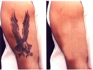 Antes y después de borrar tatuaje