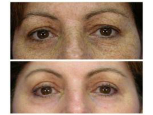 Los tipos de manchas de la piel