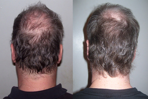 Microinjerto capilar