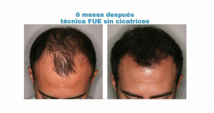 implante capilar en Clínica Esper