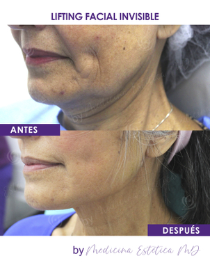 Antes y después de lifting