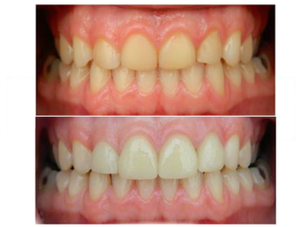 limpieza dental en chile