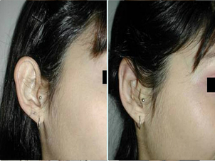 Antes y después otoplastia