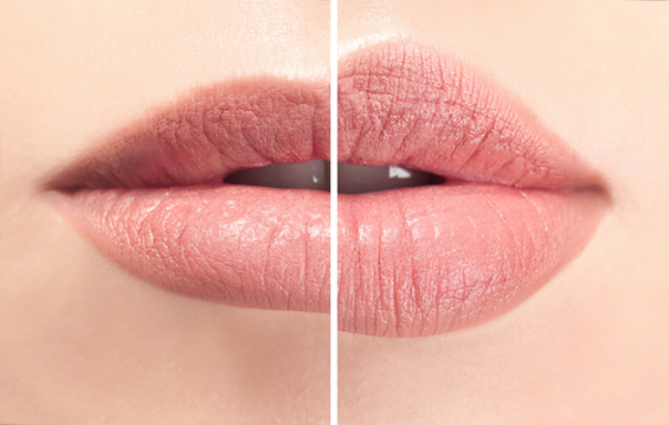 Cómo se pueden aumentar los labios