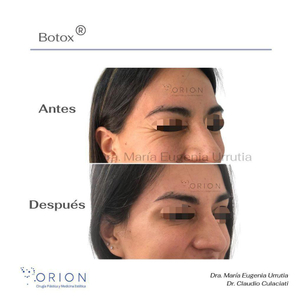 botox mujer