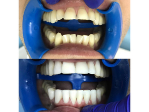 Antes y después de las carillas de porcelana