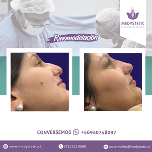 Resultados rinomodelacion