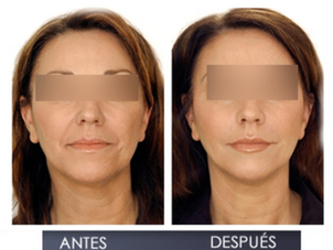 Resultados de la cirugía de aumento de pómulos