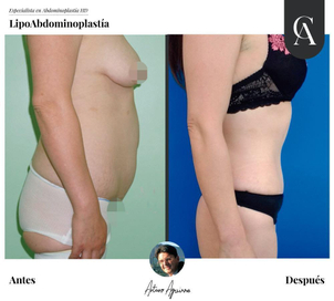 Abdominoplastia