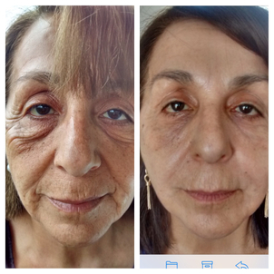 Antes y después de peeling