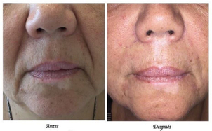 Antes y después ácido hialurónico