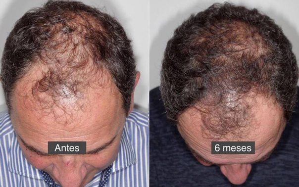 Resultados contra la alopecia