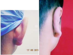 Resultados otoplastia