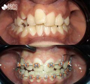 Tratamiento con brackets