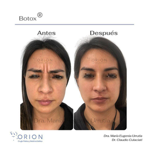 botox antes y después