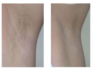 Resultados obtenidos en Illariy Clínica Médica Estética