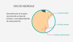 Tipos de abordaje aumento mamas