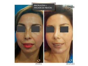 Antes y después rinoplastia y mentoplastia