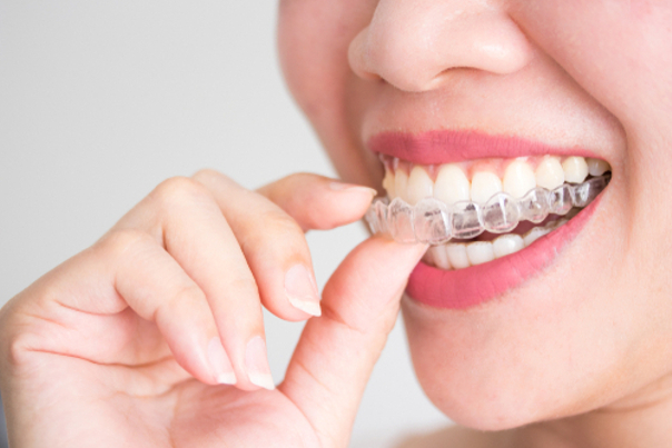 Beneficios de ortodoncia invisible