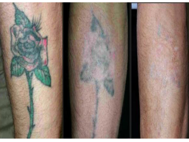 Antes y después borrar tatuaje