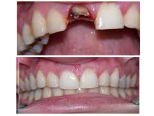 extracción de dientes