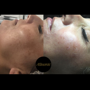 Resultados manchas en la piel