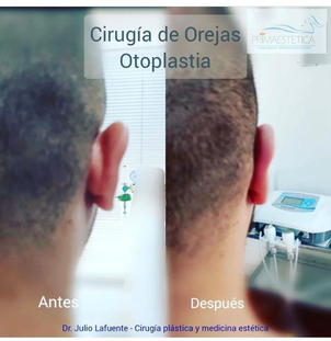 Antes y después otoplastia
